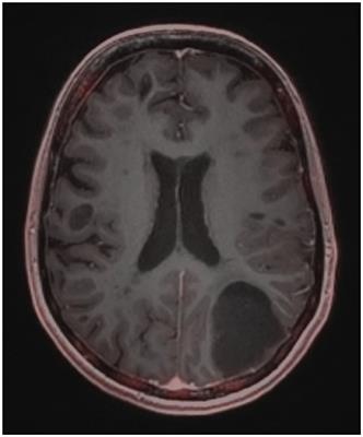 Case report: Diagnostic challenge: a new multiple sclerosis “relapse” leading to the diagnosis of anaplastic astrocytoma